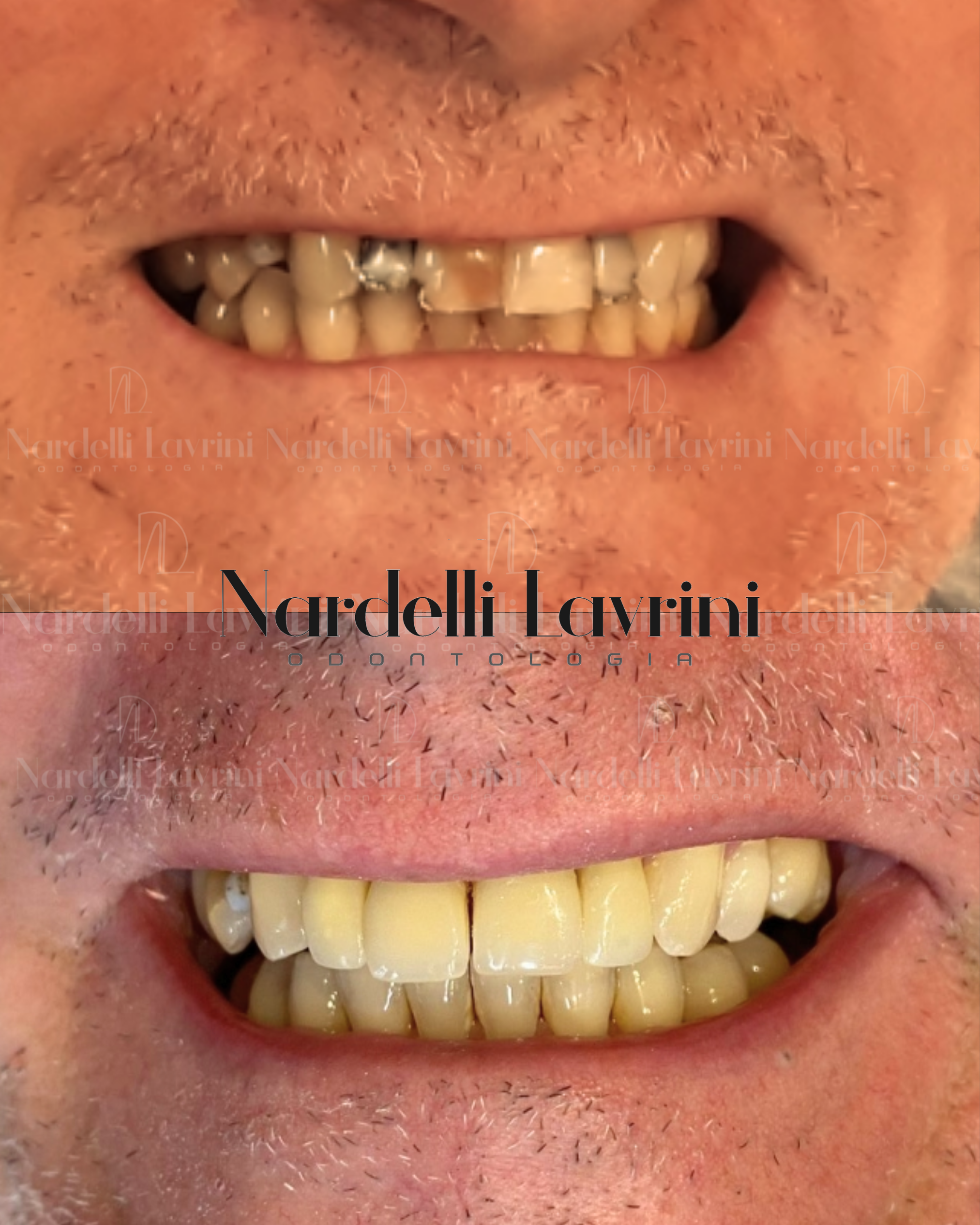 Antes e Depois